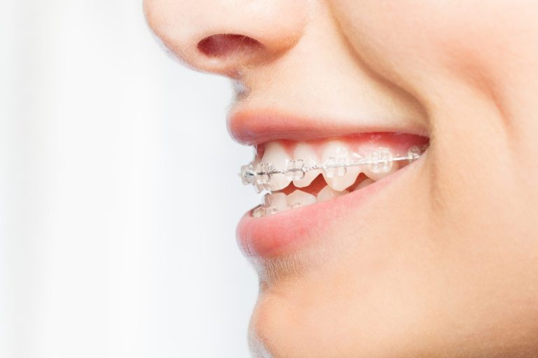 Overbite vs. Underbite: Understanding the Difference