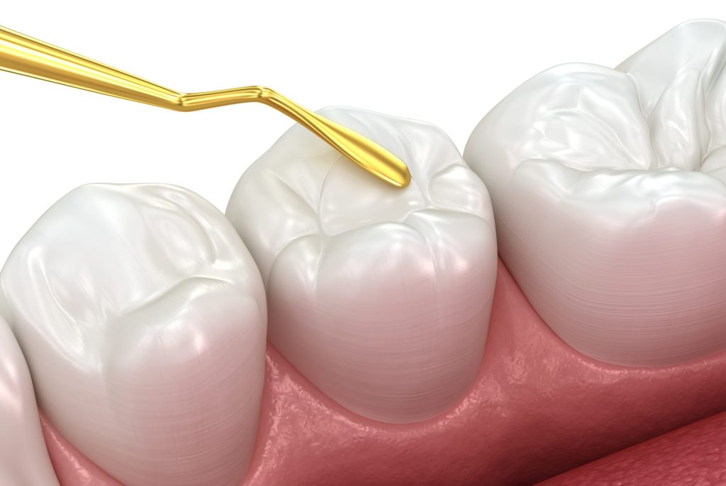 When an Old Filling Feels Rough: Should You Replace It?